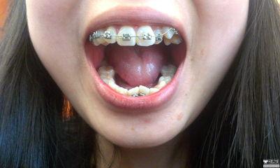 国产阴影矫正牙齿视频,揭秘牙齿阴影矫正的神奇效果